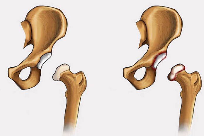 cambios dexenerativos e dor na articulación da cadeira