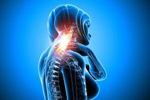 osteocondrose na columna cervical